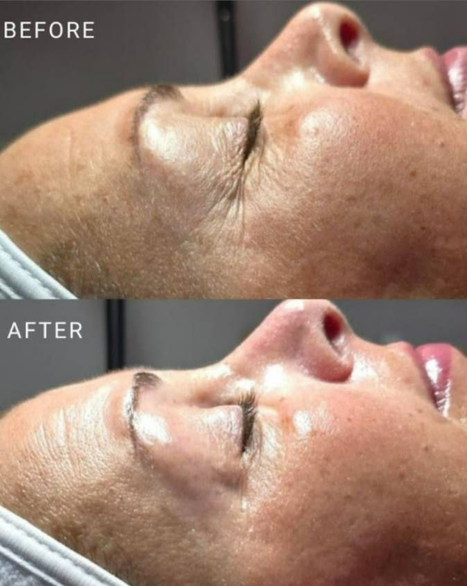 Hydrolifting Signature Facial Series- 20% OFF