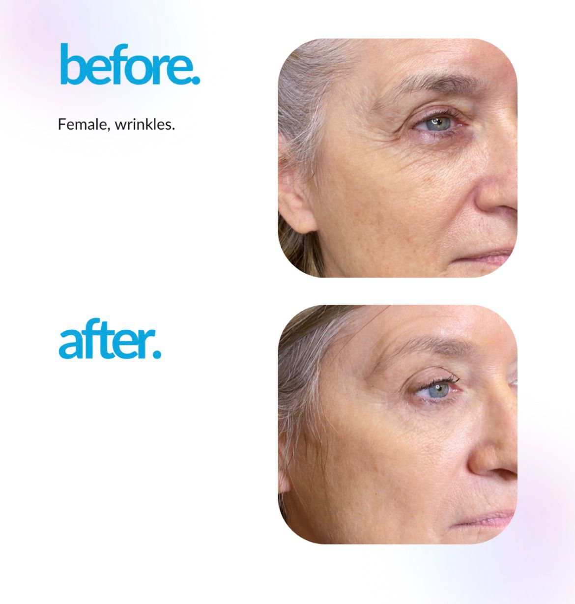 ProCell™ Microchanneling Series- 20% OFF